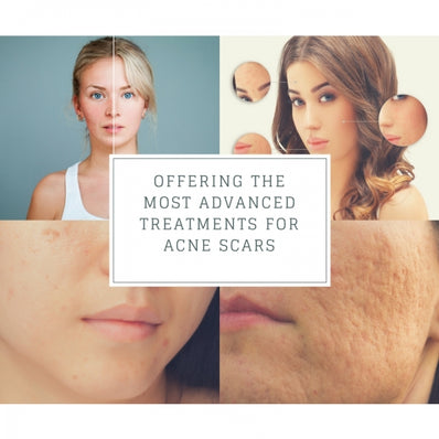 Facial Scar Theraphy